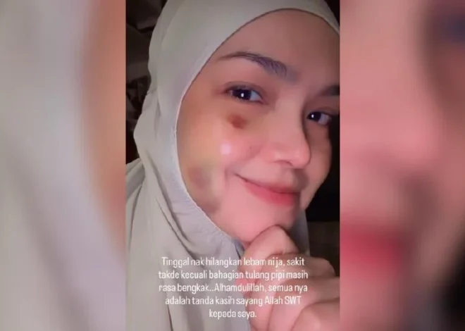 Lebam masih ada, tulang pipi rasa bengkak – Siti Nurhaliza