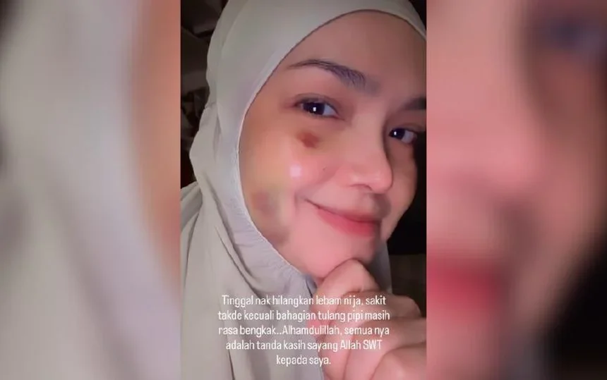 Lebam masih ada, tulang pipi rasa bengkak – Siti Nurhaliza