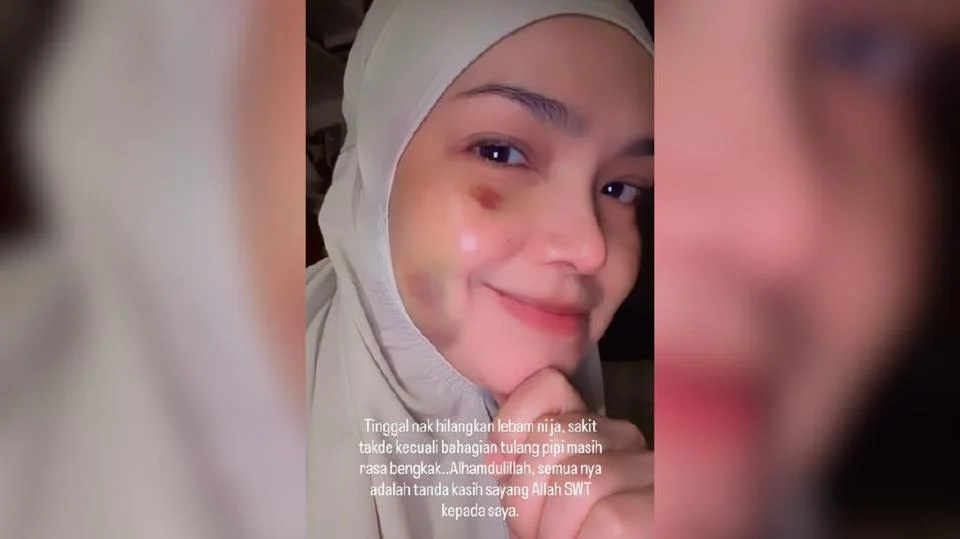 Lebam masih ada, tulang pipi rasa bengkak – Siti Nurhaliza